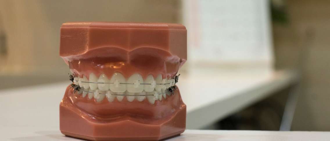 التخطيط لتثبيت تقويم الأسنان؟ فيما يلي 8 مراحل لتثبيت الأقواس الصحيحة!