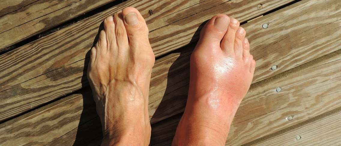 Adakah Anda Gout atau Rematik? Ketahui Perbezaannya!