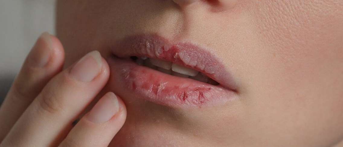 Sebab-sebab Bibir pecah-pecah, Benarkah Kekurangan Vitamin?
