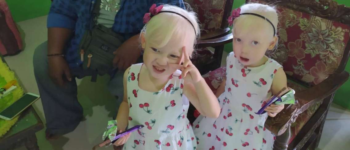Невероятни близнаци албиноси от Wonogiri, какво причинява албинос?